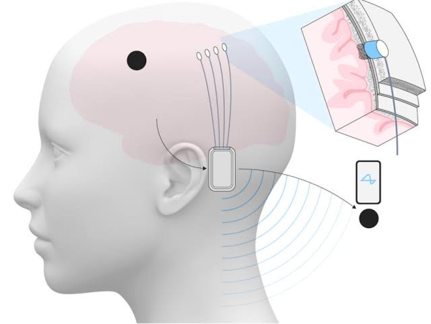 ئیلۆن ماسك ڕایگەیاند كە كۆمپانیاكەی “نیورالینك” پلانی هەیە لە ساڵی ٢٠٢٦ دەست بە بەرهەمهێنانی بڕێكی زۆر لە چیپەكانی مێشك بكات